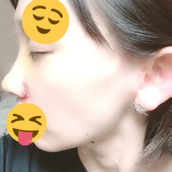 小鼻縮小（切開） / 鼻尖形成（非切開） / その他（鼻） CLINIC W DAY 3 メイン用