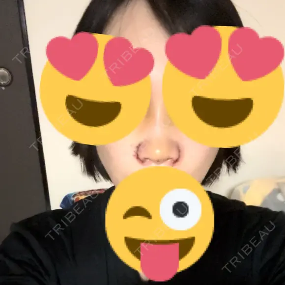 小鼻縮小（切開） / 鼻尖形成（非切開） / その他（鼻） CLINIC W DAY 2 メイン用