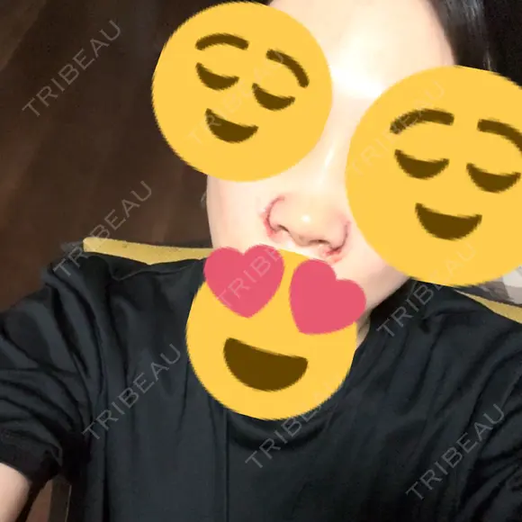 小鼻縮小（切開） / 鼻尖形成（非切開） / その他（鼻） CLINIC W DAY 1 メイン用