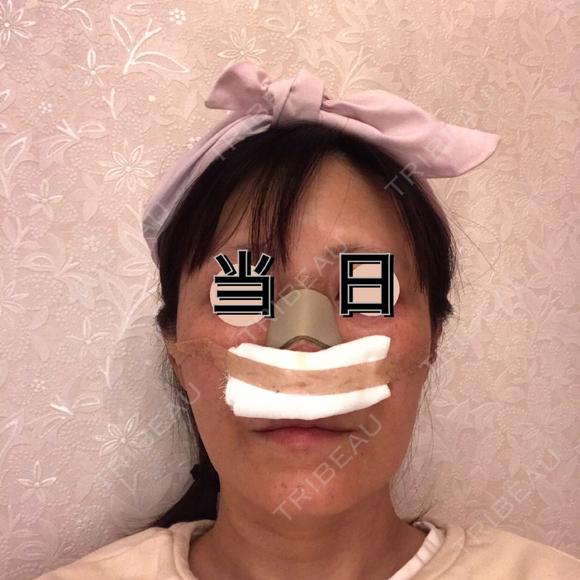 鼻尖形成（切開） / 鼻中隔延長（切開） / 軟骨移植 WOM CLINIC GINZA （ワム クリニック ギンザ） DAY 0 メイン用