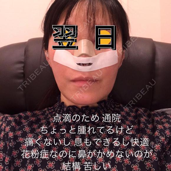 鼻尖形成（切開） / 鼻中隔延長（切開） / 軟骨移植 WOM CLINIC GINZA （ワム クリニック ギンザ） DAY 1 メイン用