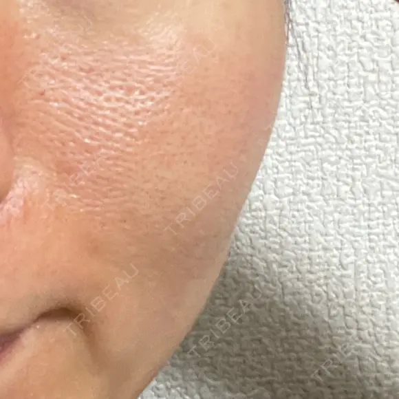 ニードルRF（ポテンツァなど） 美容皮膚科エルムクリニック 大阪院 AFTER メイン用