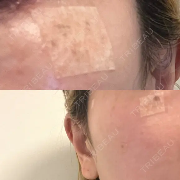 ルビーレーザー S-Laboクリニック 渋谷院 DAY 2 メイン用