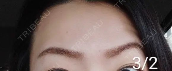 ボトックス（眉間） / ボトックス（額） / その他（鼻） 湘南美容クリニック 宇都宮院 DAY 5 メイン用