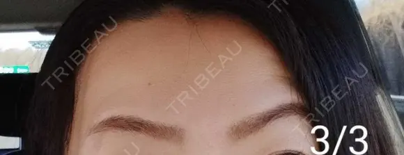 ボトックス（眉間） / ボトックス（額） / その他（鼻） 湘南美容クリニック 宇都宮院 DAY 6 メイン用