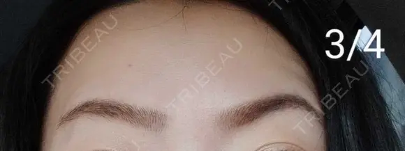 ボトックス（眉間） / ボトックス（額） / その他（鼻） 湘南美容クリニック 宇都宮院 DAY 7 メイン用