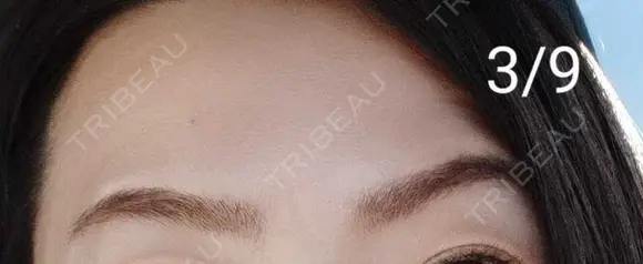 ボトックス（眉間） / ボトックス（額） / その他（鼻） 湘南美容クリニック 宇都宮院 DAY 12 メイン用