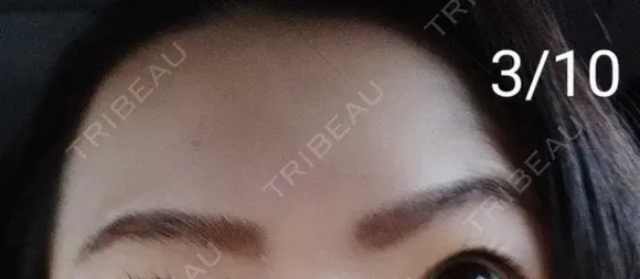 ボトックス（眉間） / ボトックス（額） / その他（鼻） 湘南美容クリニック 宇都宮院 AFTER メイン用