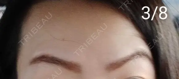 ボトックス（眉間） / ボトックス（額） / その他（鼻） 湘南美容クリニック 宇都宮院 DAY 11 メイン用