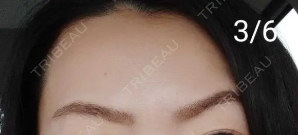 ボトックス（眉間） / ボトックス（額） / その他（鼻） 湘南美容クリニック 宇都宮院 DAY 9 メイン用