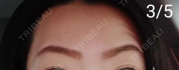 ボトックス（眉間） / ボトックス（額） / その他（鼻） 湘南美容クリニック 宇都宮院 DAY 8 メイン用