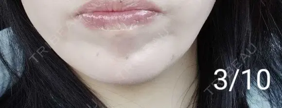 ボトックス（あご） 湘南美容クリニック 宇都宮院 AFTER メイン用