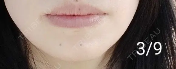 ボトックス（あご） 湘南美容クリニック 宇都宮院 DAY 12 メイン用