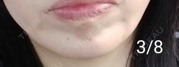 ボトックス（あご） 湘南美容クリニック 宇都宮院 DAY 11 メイン用