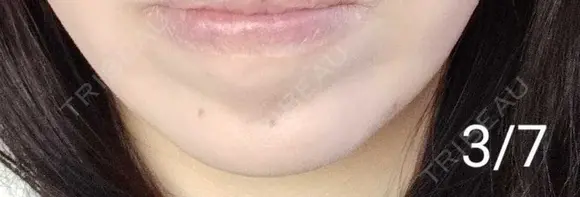 ボトックス（あご） 湘南美容クリニック 宇都宮院 DAY 10 メイン用