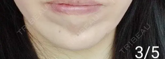 ボトックス（あご） 湘南美容クリニック 宇都宮院 DAY 8 メイン用