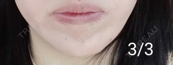 ボトックス（あご） 湘南美容クリニック 宇都宮院 DAY 6 メイン用