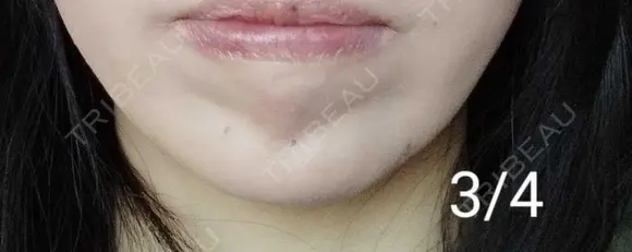 ボトックス（あご） 湘南美容クリニック 宇都宮院 DAY 7 メイン用