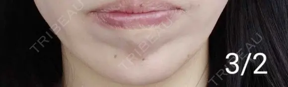 ボトックス（あご） 湘南美容クリニック 宇都宮院 DAY 5 メイン用