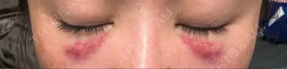 クマ治療 / 下まぶたの脂肪取り Tokyo Tensei Clinic 新宿院 DAY 2 メイン用