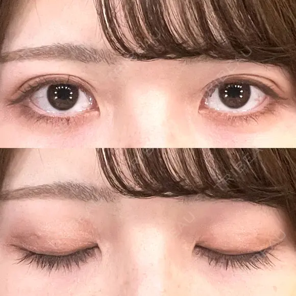 二重埋没 ルラ美容クリニック 渋谷本院 DAY 17 メイン用