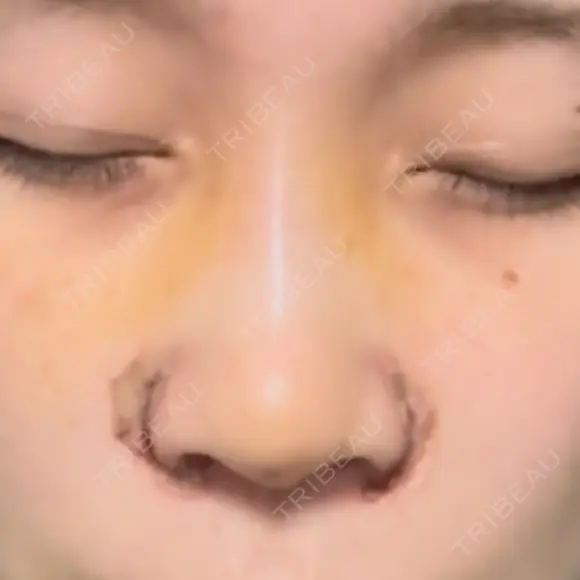 小鼻縮小（切開） / 鼻尖形成（非切開） / その他（鼻） CLINIC W DAY 5 メイン用