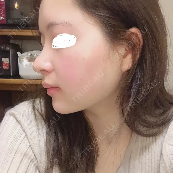 鼻尖形成（切開） / 鼻中隔延長（切開） / 小鼻縮小（切開） / 軟骨移植 / 鼻尖縮小 HANABI整形外科 DAY 11 メイン用