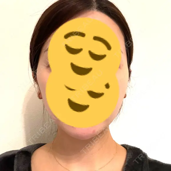 糸リフト / 脂肪吸引注射（顔） 湘南美容クリニック 吉祥寺院 DAY 58 メイン用