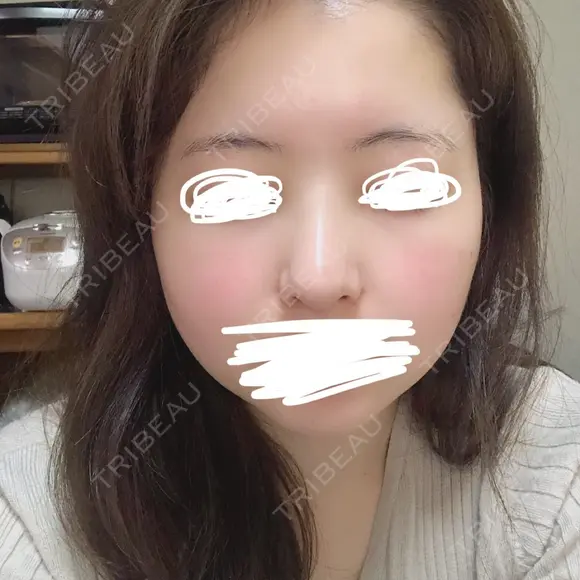 鼻尖形成（切開） / 鼻中隔延長（切開） / 小鼻縮小（切開） / 軟骨移植 / 鼻尖縮小 HANABI整形外科 DAY 11 メイン用
