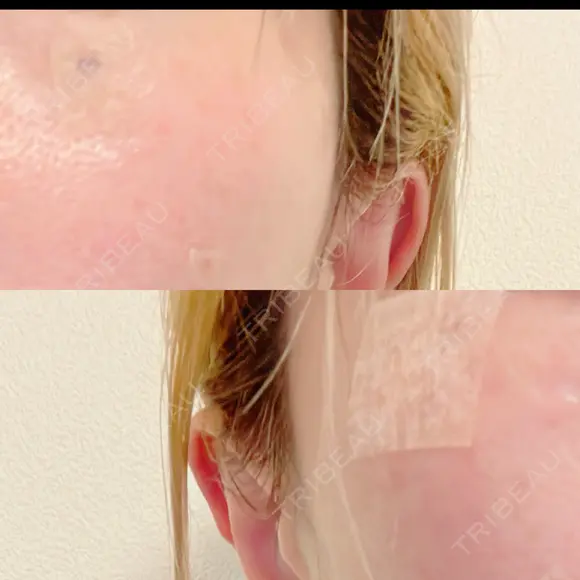 ルビーレーザー S-Laboクリニック 渋谷院 DAY 4 メイン用