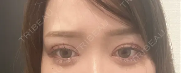 二重埋没 / 目頭切開 / 糸リフト / 脂肪吸引（顔） / ヒアルロン酸注入（涙袋） R Beauty CLINIC 名古屋院 DAY 30 メイン用