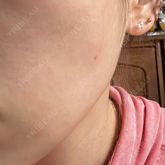 ボトックス（エラ・小顔） / ボトックス（肩） ルラ美容クリニック 横浜院 AFTER メイン用