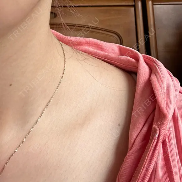 ボトックス（エラ・小顔） / ボトックス（肩） ルラ美容クリニック 横浜院 DAY 0 メイン用