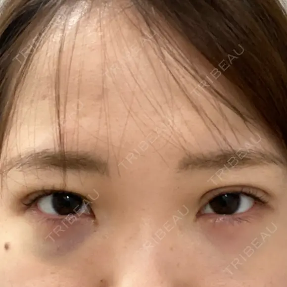 二重埋没 / クマ治療 R Beauty CLINIC 名古屋院 DAY 1 メイン用