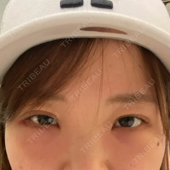 二重埋没 / クマ治療 R Beauty CLINIC 名古屋院 DAY 1 メイン用
