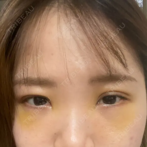 二重埋没 / クマ治療 R Beauty CLINIC 名古屋院 DAY 1 メイン用
