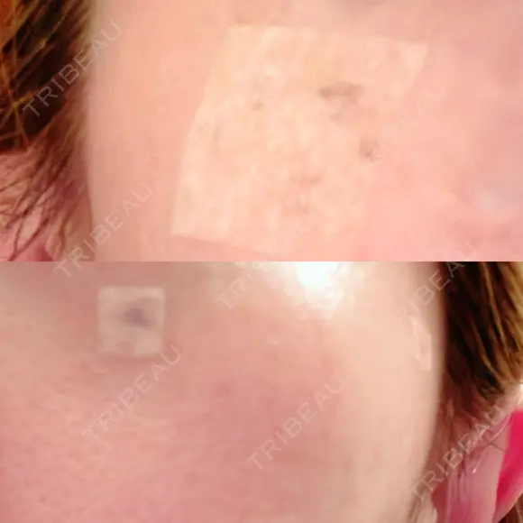 ルビーレーザー S-Laboクリニック 渋谷院 DAY 5 メイン用