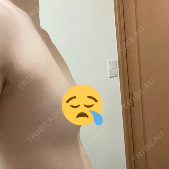 豊胸（脂肪注入） 銀座マイアミ美容外科 DAY 11 メイン用