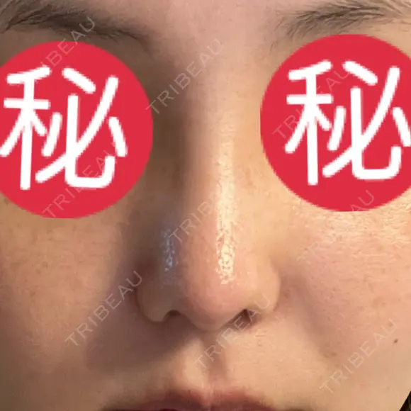 小鼻縮小（切開） / 軟骨移植 / 眉間プロテーゼ / 鼻尖形成（非切開） / 鼻柱下降・鼻唇角形成（猫手術） グローバルビューティークリニック 東京院 DAY 30 メイン用
