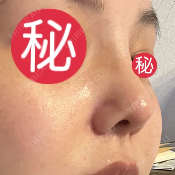小鼻縮小（切開） / 軟骨移植 / 眉間プロテーゼ / 鼻尖形成（非切開） / 鼻柱下降・鼻唇角形成（猫手術） グローバルビューティークリニック 東京院 DAY 30 メイン用