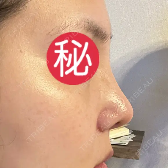 小鼻縮小（切開） / 軟骨移植 / 眉間プロテーゼ / 鼻尖形成（非切開） / 鼻柱下降・鼻唇角形成（猫手術） グローバルビューティークリニック 東京院 DAY 30 メイン用