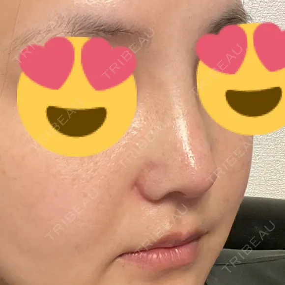 小鼻縮小（切開） / 軟骨移植 / 眉間プロテーゼ / 鼻尖形成（非切開） / 鼻柱下降・鼻唇角形成（猫手術） グローバルビューティークリニック 東京院 DAY 10 メイン用