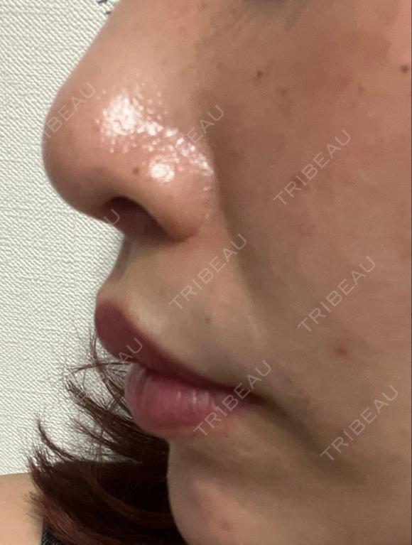 小鼻縮小（切開） / 人中短縮 / 鼻翼挙上 Otus Clinic 【オータスクリニック】 DAY 181 メイン用