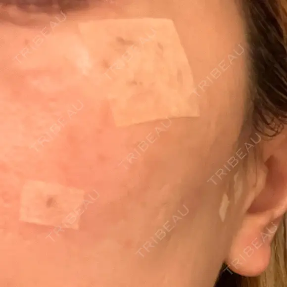 ルビーレーザー S-Laboクリニック 渋谷院 DAY 7 メイン用