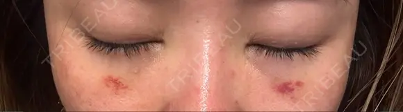 クマ治療 / 下まぶたの脂肪取り Tokyo Tensei Clinic 新宿院 DAY 7 メイン用