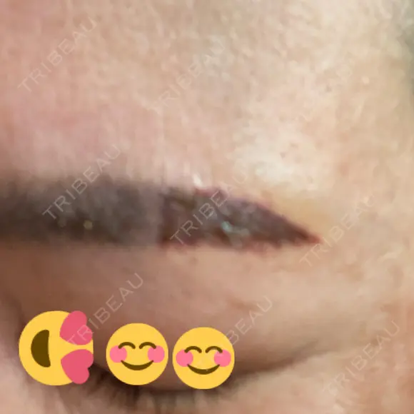 タトゥー除去 渋谷美容外科クリニック 池袋院 AFTER メイン用