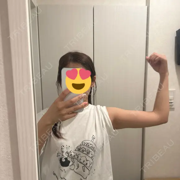 脂肪吸引（二の腕） Mods Clinic（モッズクリニック） 東京院 AFTER メイン用