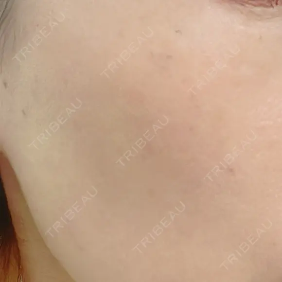 ルビーレーザー S-Laboクリニック 渋谷院 AFTER メイン用