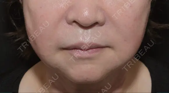 糸リフト / ヒアルロン酸注入（首） 藤・ナチュレ美容クリニック 銀座院 DAY 0 メイン用