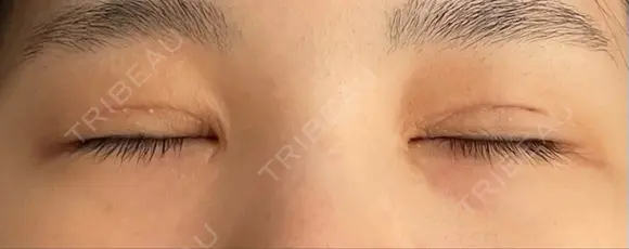 二重切開 / 目頭切開 / 上まぶたたるみ取り 湘南美容クリニック 大阪堺東院 DAY 85 メイン用